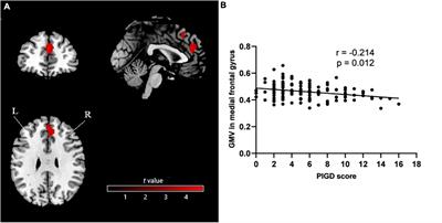 Differences in neuroanatomy and functional connectivity between motor subtypes of Parkinson’s disease